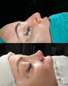 نتائج عملية تجميل الأنف قبل وبعد في ÜMRAN TIP MERKEZİ، تحسين شكل الأنف