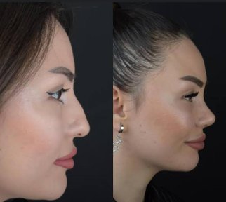 نتائج عملية تجميل الأنف قبل وبعد في ÜMRAN TIP MERKEZİ، تحسين شكل الأنف
