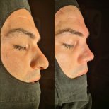 Vorher-nachher-Rhinoplastik-Ergebnis bei ÜMRAN TIP MERKEZİ, verbesserte Nasenform