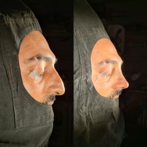 Vorher-nachher-Ergebnis der Nasenkorrektur bei ÜMRAN TIP MERKEZİ, verbesserte Nasenform