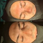 Vorher-nachher-Rhinoplastik-Ergebnisse bei ÜMRAN TIP MERKEZİ, verbesserte Nasenform