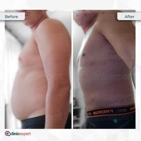 Vorher-nachher-Ergebnis der Bauchliposuktion bei CE International Hospital, flacher Bauch