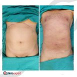 Vorher-nachher-Ergebnisse der Bauchliposuktion bei CE International Hospital, Körperkontur