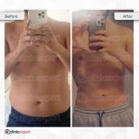 Vorher-nachher-Ergebnis der Bauchliposuktion bei CE International Hospital, schlankere Taille