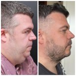 Vorher-nachher-Ergebnis Deep Plane Facelift bei VG Plastic Surgery, definierte Kieferlinie