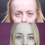 Vorher-nachher-Ergebnis der Blepharoplastik bei VG Plastic Surgery, Lidkorrektur