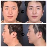 Vorher-nachher-Ergebnis Halsstraffung bei VG Plastic Surgery, verbesserte Kontur