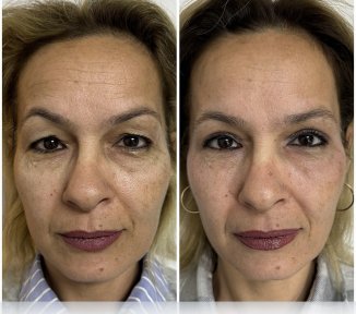 Before and after blepharoplasty results at ÜMRAN TIP MERKEZİ, eyelid correction procedure