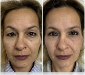 Before and after blepharoplasty results at ÜMRAN TIP MERKEZİ, eyelid correction procedure