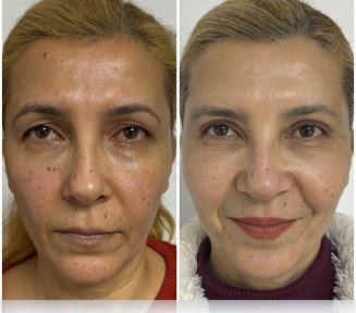 Before and after blepharoplasty results at ÜMRAN TIP MERKEZİ, eyelid correction improvement