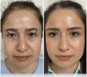 Before and after blepharoplasty results at ÜMRAN TIP MERKEZİ, eyelid correction procedure