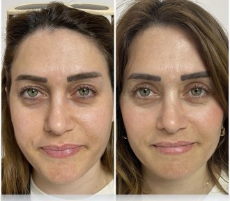 Before and after blepharoplasty results at ÜMRAN TIP MERKEZİ, eyelid correction improvement