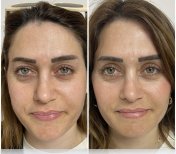 Before and after blepharoplasty results at ÜMRAN TIP MERKEZİ, eyelid correction improvement