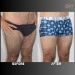 Before and after thigh lift results at ID Clinic Bangkok, improved thigh contour in male patient