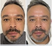 Before and after blepharoplasty results at ÜMRAN TIP MERKEZİ, eyelid correction for men