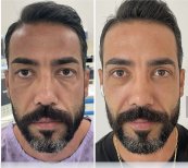 Before and after blepharoplasty results at ÜMRAN TIP MERKEZİ, eyelid correction for men