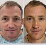 Before and after blepharoplasty results at ÜMRAN TIP MERKEZİ, eyelid correction for men