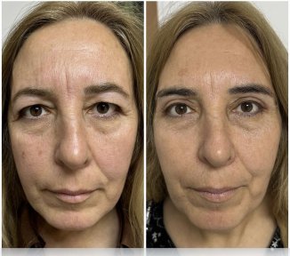Before and after blepharoplasty results at ÜMRAN TIP MERKEZİ, eyelid correction procedure