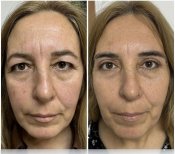 Before and after blepharoplasty results at ÜMRAN TIP MERKEZİ, eyelid correction procedure