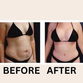 Before and after tummy tuck and liposuction results at ID Clinic Bangkok, flatter abdomen