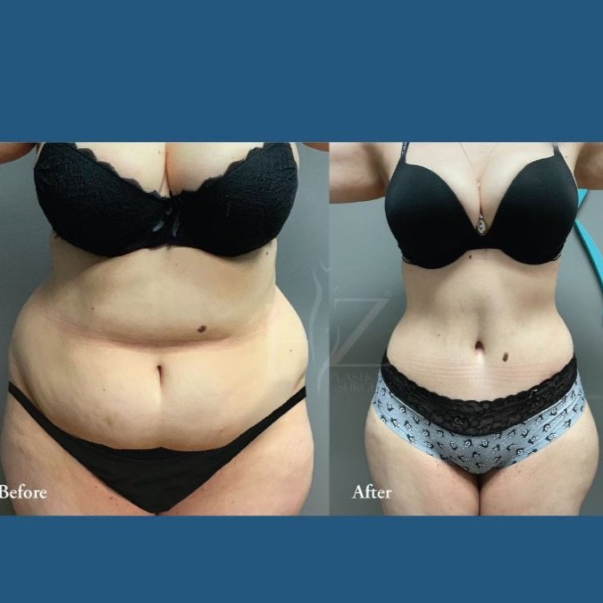 نتائج شد البطن وشفط الدهون قبل وبعد في ID Clinic Bangkok، تحسين محيط الخصر
