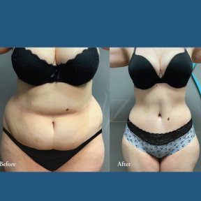Before and after tummy tuck and liposuction results at ID Clinic Bangkok, improved waistline