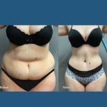 Before and after tummy tuck and liposuction results at ID Clinic Bangkok, improved waistline