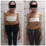 Vorher-nachher-Ergebnis der Skoliose-OP in der NP Istanbul Brain Hospital, bessere Haltung