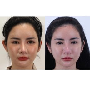 Before and after otoplasty results at Wansiri Hospital, ear reshaping with natural outcome
