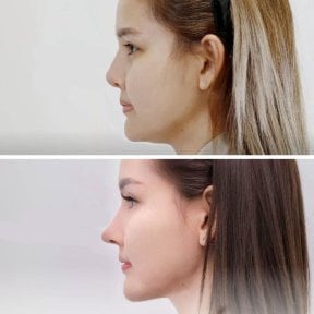 Before and after rhinoplasty result at Wansiri Hospital, nose reshaping with natural look