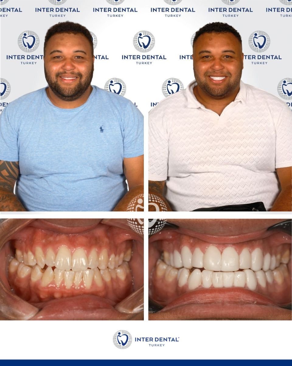 Résultats avant/après restauration dentaire (bonding) chez Inter Dental Turkey, sourire amélioré