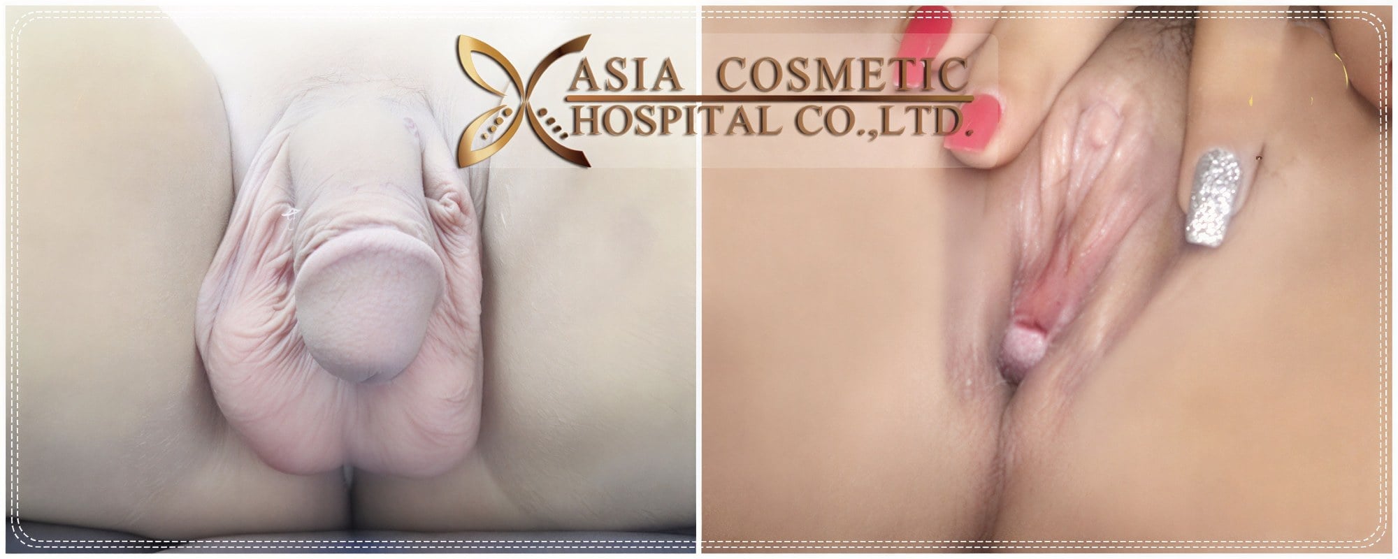 نتائج قبل وبعد عملية تجميل المهبل في Asia Cosmetic Hospital، نتيجة تغيير الجنس