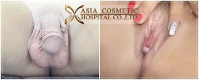 Before and after vaginoplasty results at Asia Cosmetic Hospital, gender confirmation surgery outcome