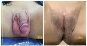 Before and after vaginoplasty results at Asia Cosmetic Hospital, gender confirmation surgery outcome
