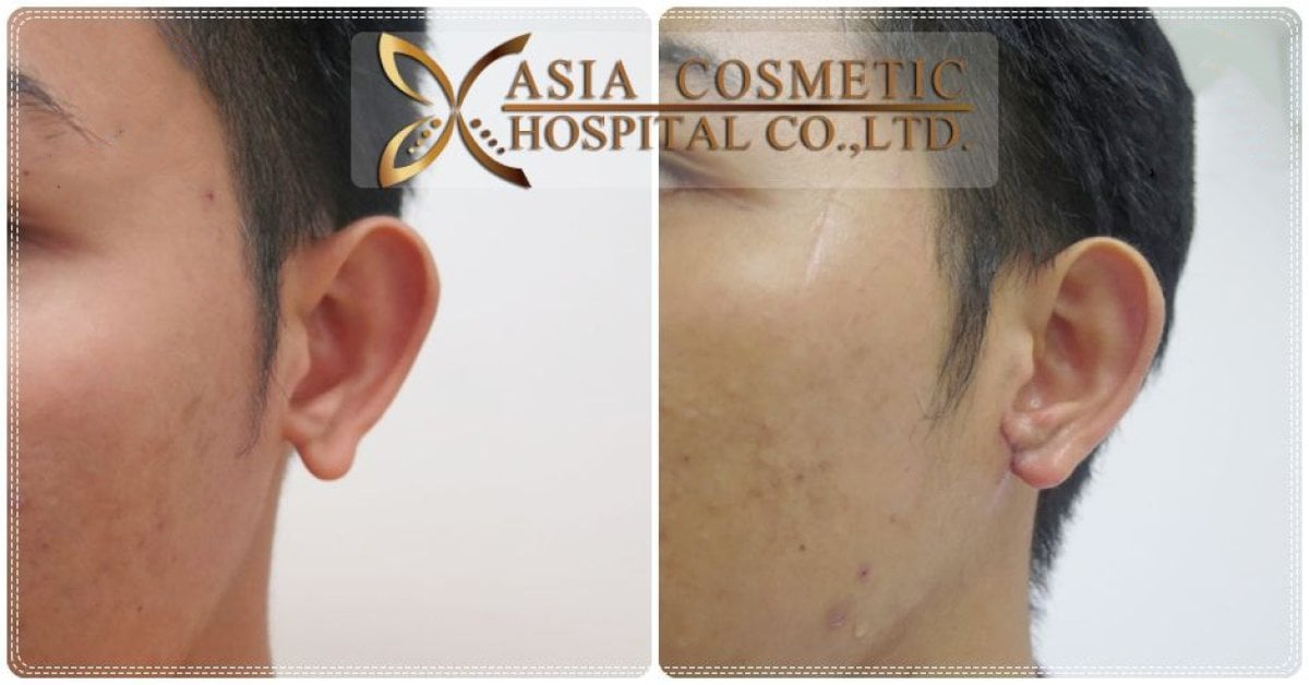 Resultados de otoplastia antes y después en Asia Cosmetic Hospital, mejora de la forma de la oreja