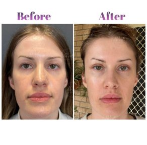 Vorher-nachher-Ergebnis Oberlidstraffung bei Db'est Clinic, sichtbare Augenverjüngung