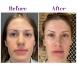 Vorher-nachher-Ergebnis Oberlidstraffung bei Db'est Clinic, sichtbare Augenverjüngung