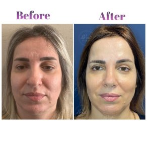 Vorher-nachher-Ergebnis Oberlidstraffung bei Db'est Clinic – verjüngtes Aussehen