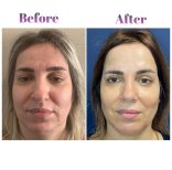 Vorher-nachher-Ergebnis Oberlidstraffung bei Db'est Clinic – verjüngtes Aussehen