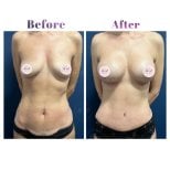 Before and after breast lift results at Db'est Clinic, visible breast contour improvement