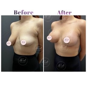 Before and after breast lift results at Db'est Clinic – improved breast shape and contour