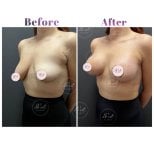 Before and after breast lift results at Db'est Clinic – improved breast shape and contour