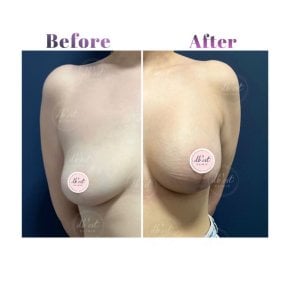 Before and after breast lift results at Db'est Clinic showing lifted, firmer breast contour