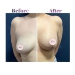 Before and after breast lift results at Db'est Clinic showing lifted, firmer breast contour