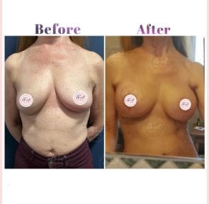 Before and after breast lift results at Db'est Clinic, improved breast contour and firmness