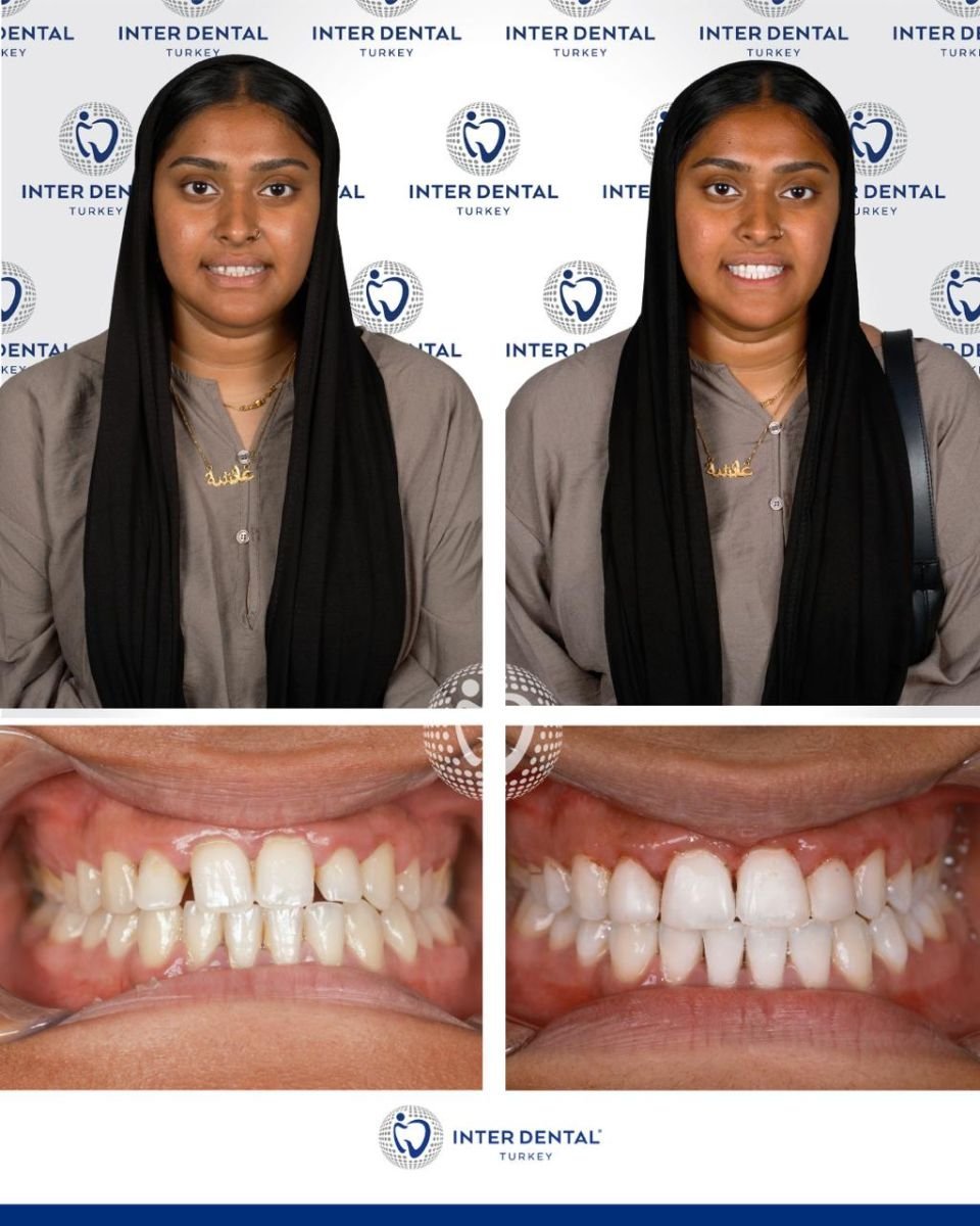 Résultats avant/après restauration dentaire (bonding) chez Inter Dental Turkey, sourire amélioré