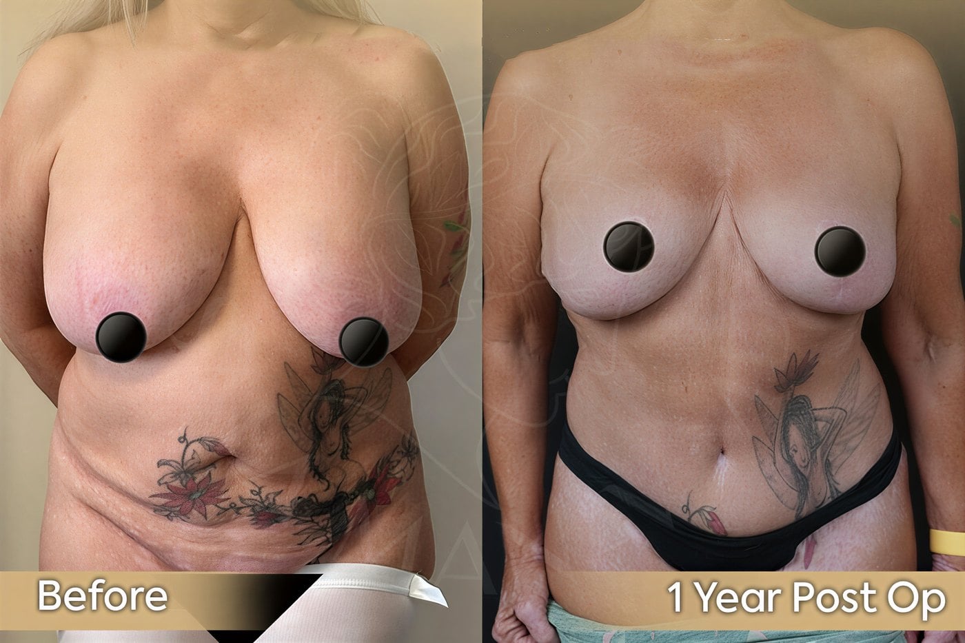 Resultados antes y después de extracción de implantes mamarios en Dr. Safa Manav Clinic, 1 año