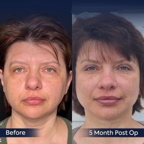 Vorher-nachher-Ergebnis Oberlidstraffung bei Dr. Safa Manav Clinic, 5 Monate postoperativ