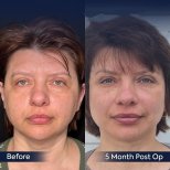Vorher-nachher-Ergebnis Oberlidstraffung bei Dr. Safa Manav Clinic, 5 Monate postoperativ