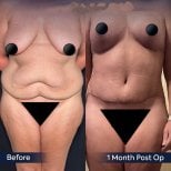 Vorher-nachher-Ergebnis Bauchdeckenstraffung bei Dr. Safa Manav – flacher Bauch nach 1 Monat